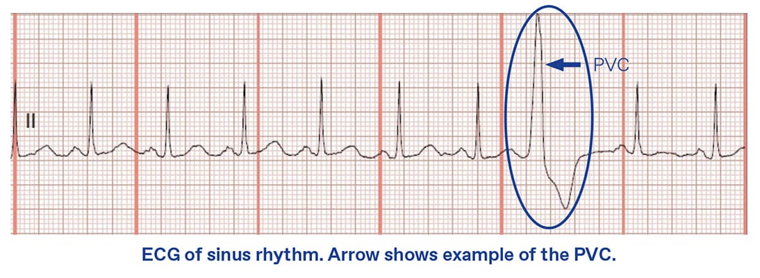 Premature Ventricular Complex (PVC)/Ventricular Tachycardia (VT) Ablation