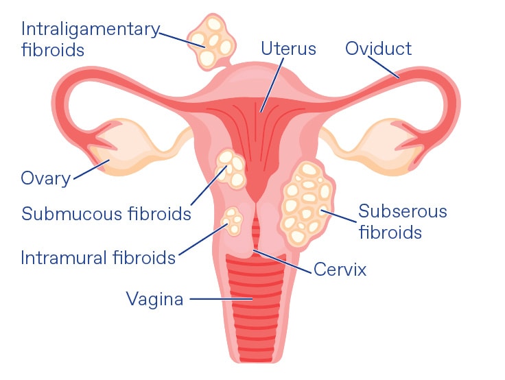 tirzepatide fibroids Uterine Fibroid Embolisation