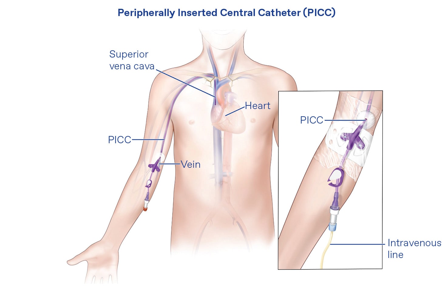 Peripherally Inserted Central Catheter (PICC) | IntraCare