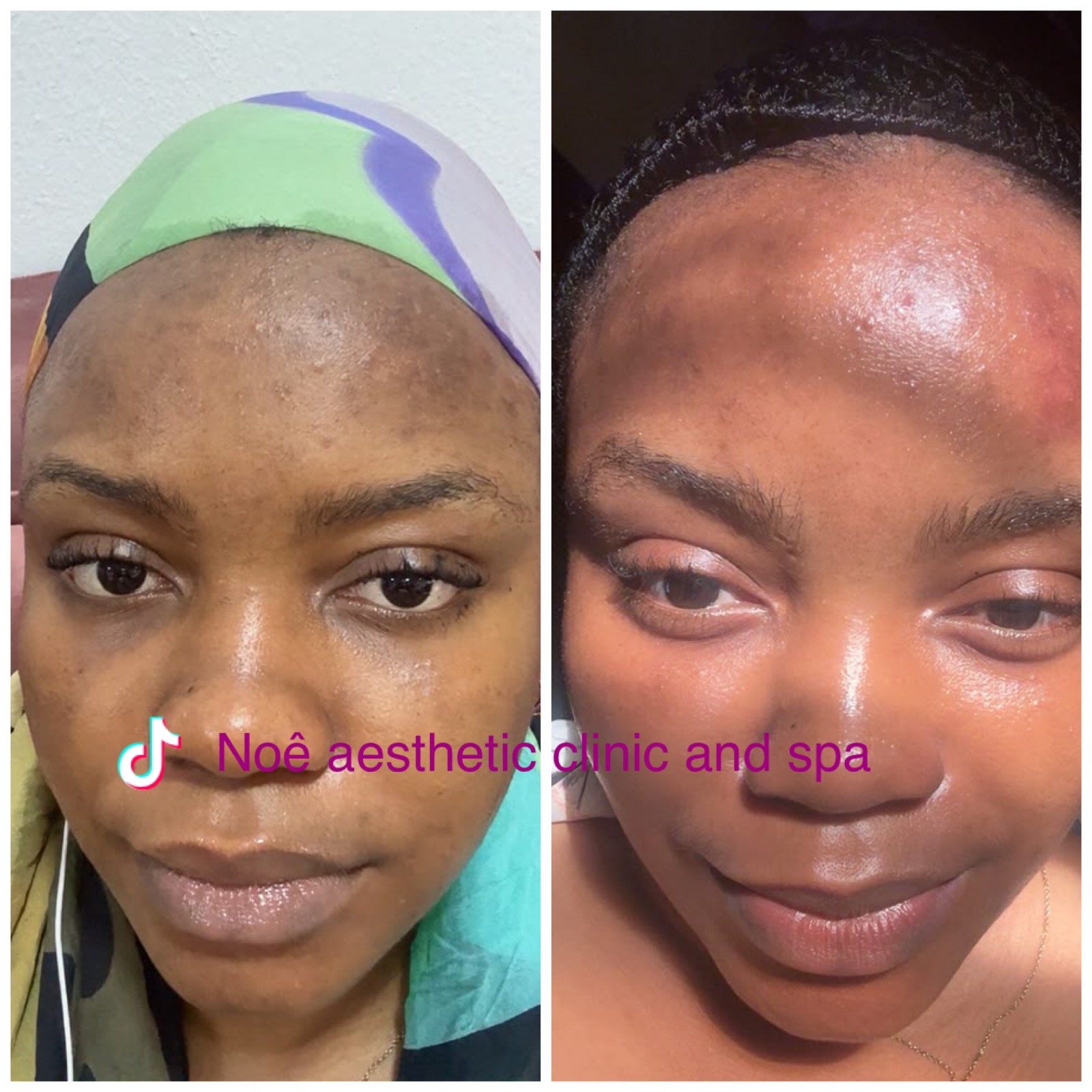 Advanced facials