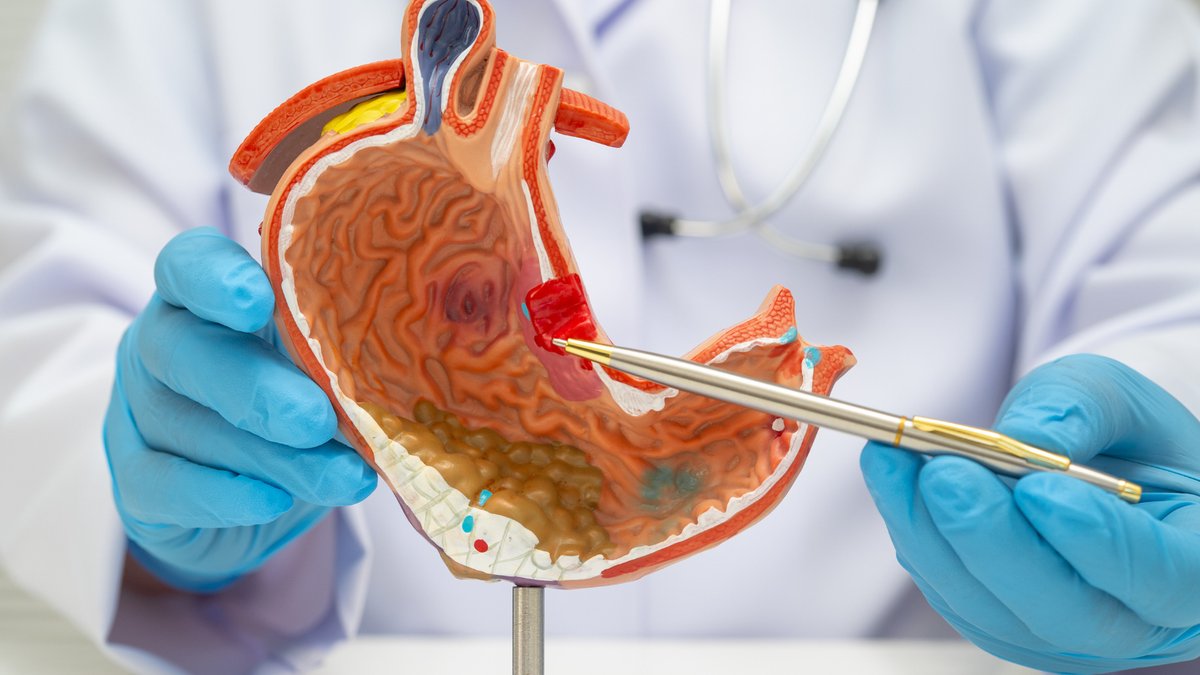 New Treatment Boosts Survival in Biliary Cancer - biliary cancer