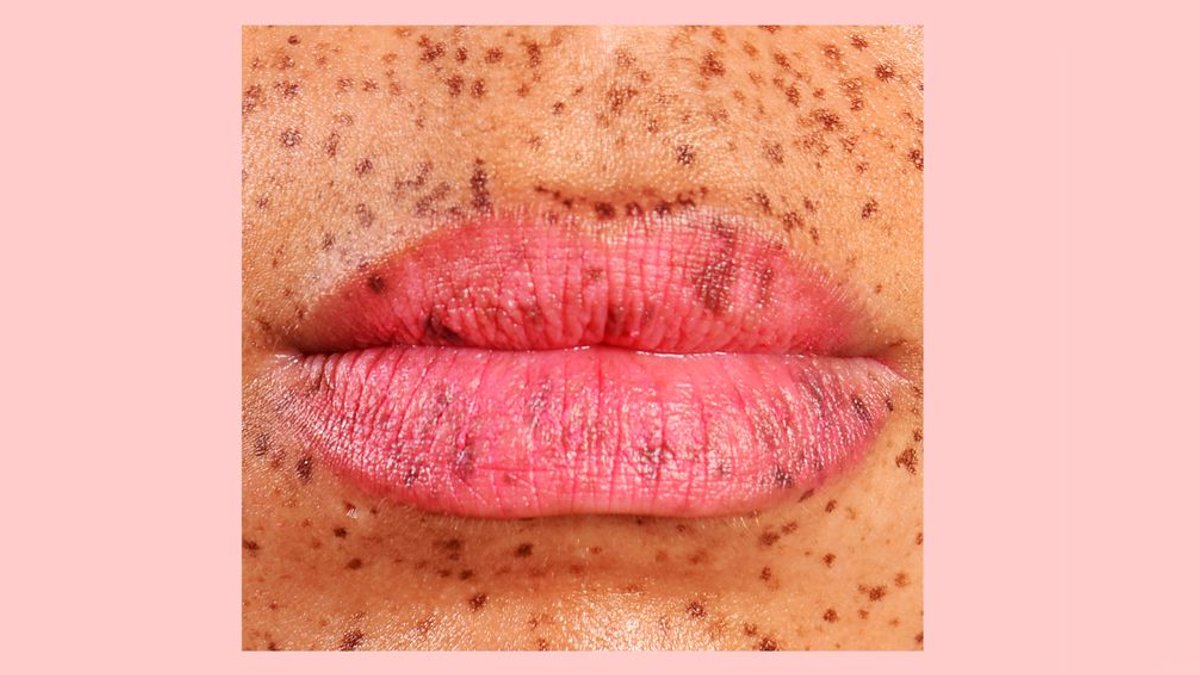 Quick fixes for painful cracked lip corners Quick fixes for painful cracked lip corners - cracked lip corners