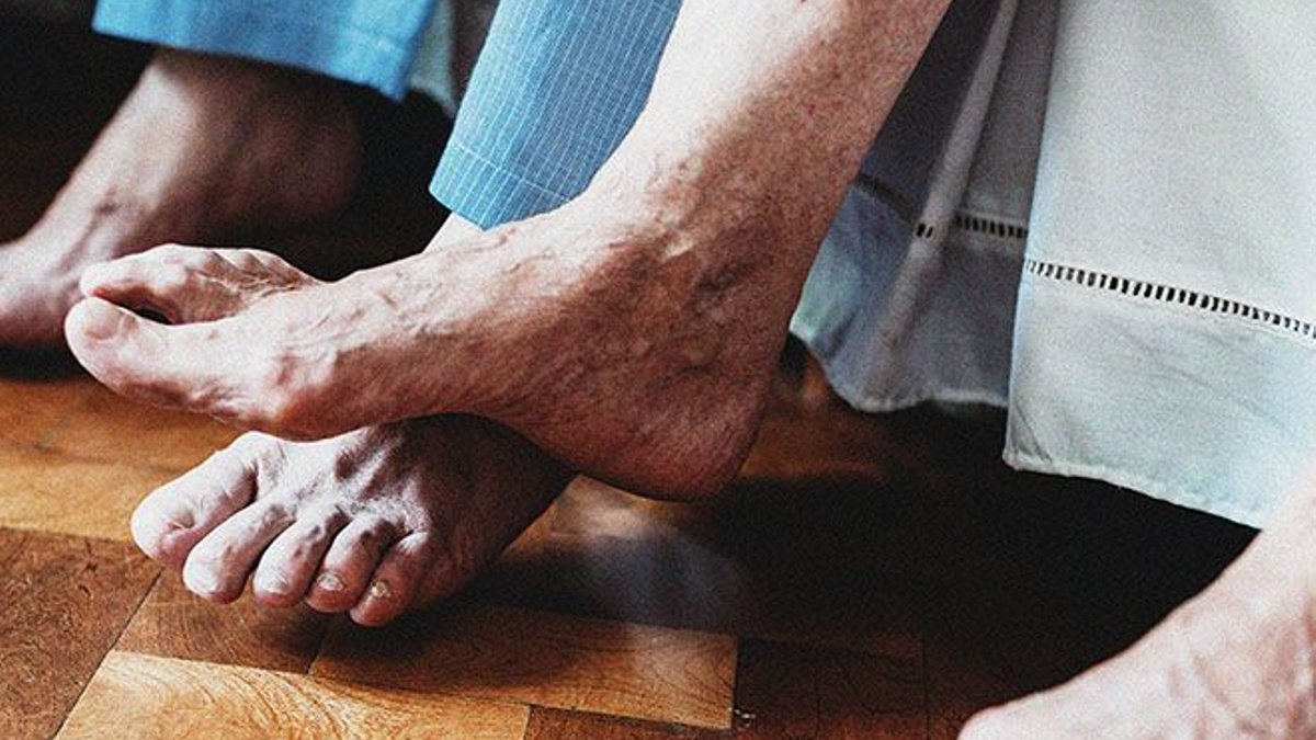 Global Rheumatoid Arthritis Cases Rising, Early Diagnosis Key - rheumatoid arthritis
