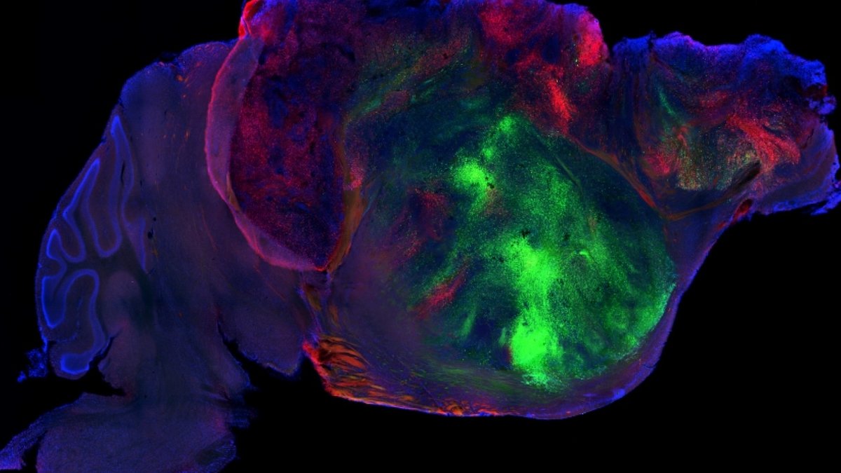Grafted human brain tissue thrives in cortex-depleted mice - human brain tissue grafts