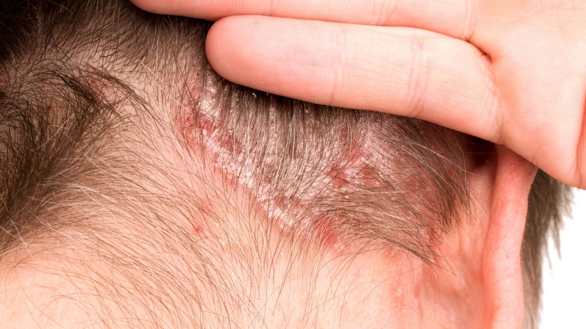Risankizumab Outperforms Deucravacitinib in Moderate Plaque Psoriasis Risankizumab Outperforms Deucravacitinib in Moderate Plaque Psoriasis - risankizumab psoriasis
