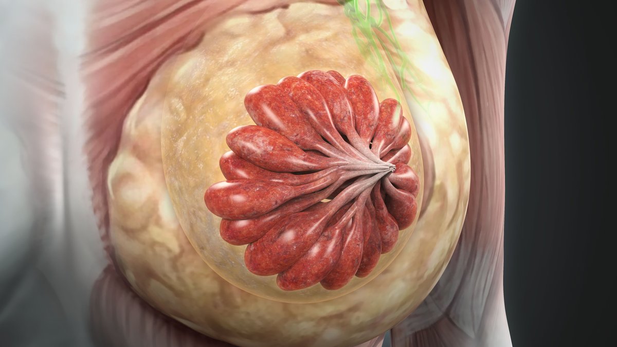 Kazia Expands Trial of Paxalisib for Advanced Breast Cancer - paxalisib trial