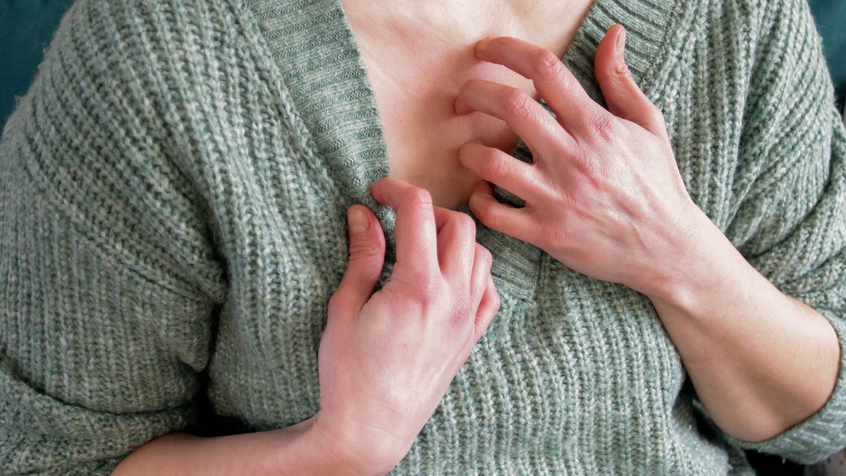 62-Year-Old Woman Endures Two Years of Hives 62-Year-Old Woman Endures Two Years of Hives - chronic hives