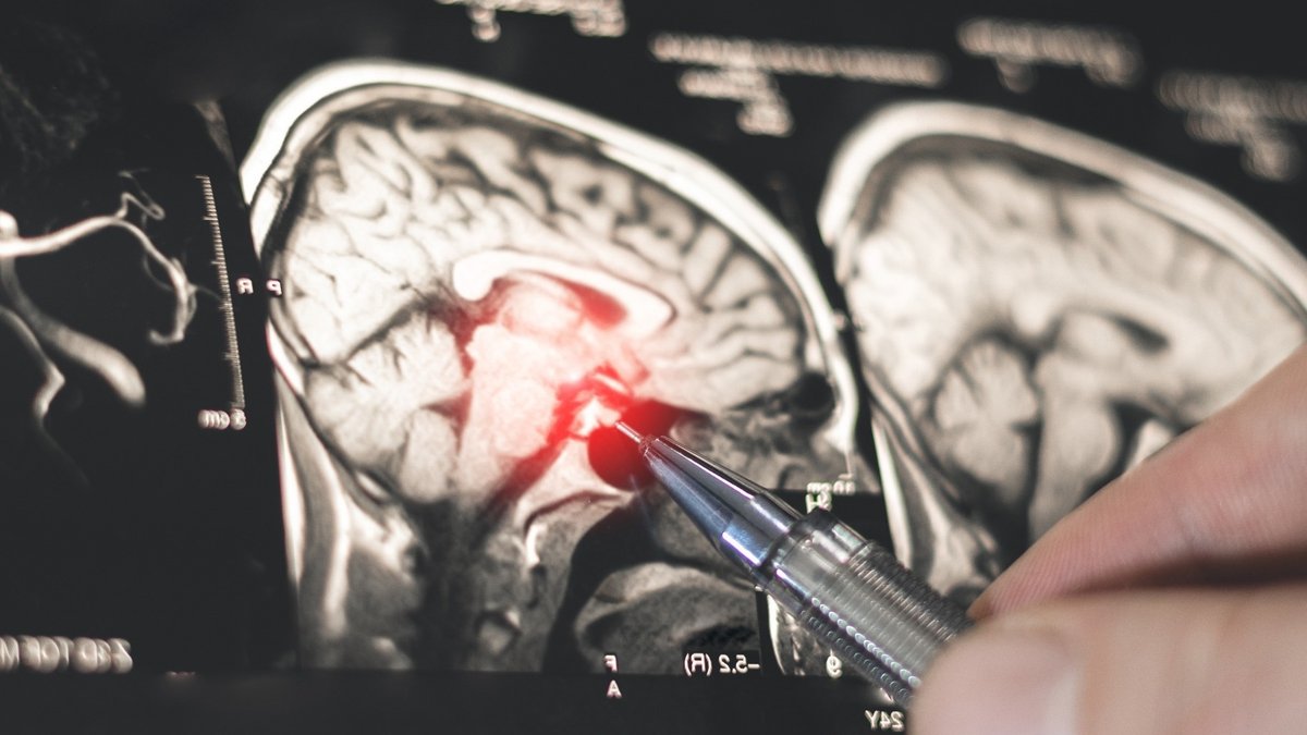 New AI tool distinguishes epilepsy from functional seizures - ai tool