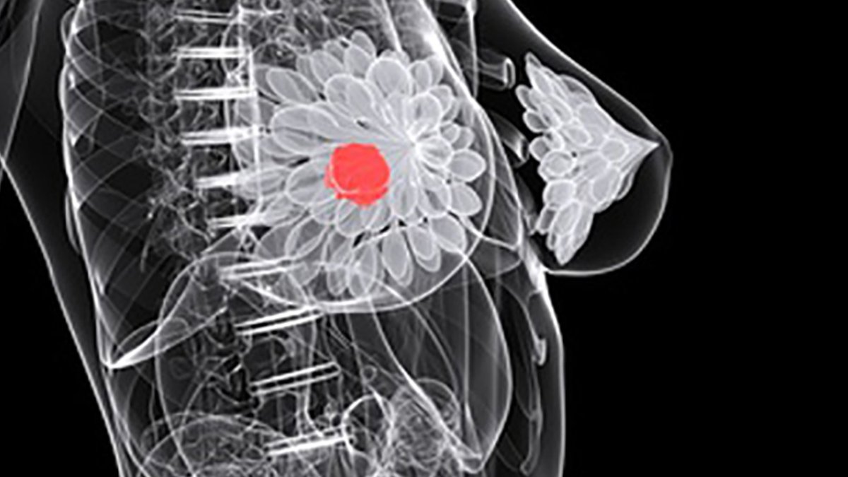 Young, Low-Income Women Face Breast Cancer Treatment Delays - breast cancer