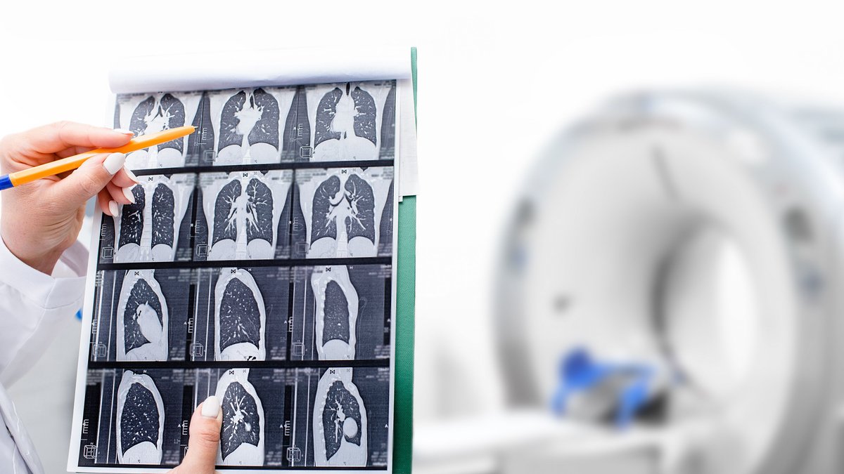 New CT Methods Predict Fibrosis Progression and Drug Effects - ct methods predict fibrosis