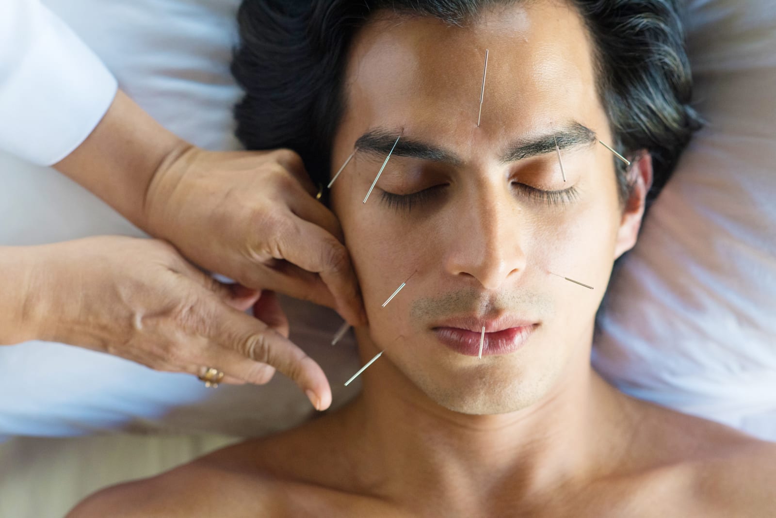 Man receiving acupuncture treatment on face and forehead