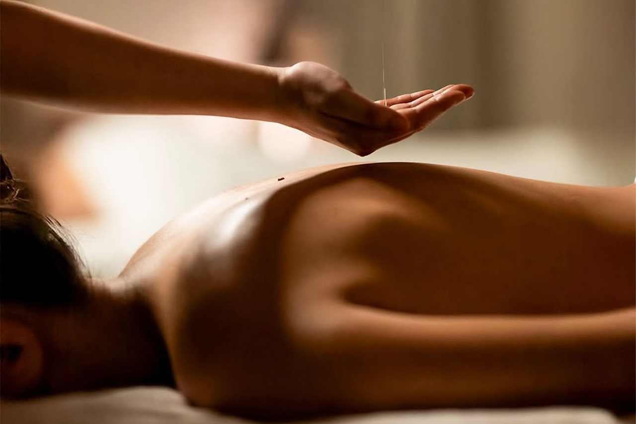 Terapia de acupuntura en el spa del hotel