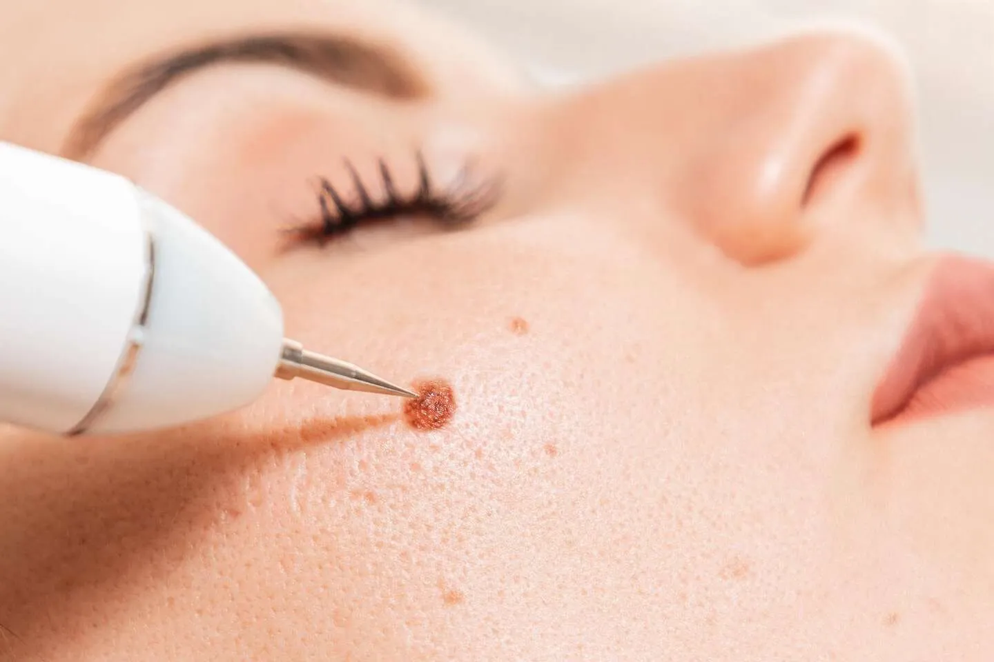 Tiny Touch Cauter treatment at SAS Clinic