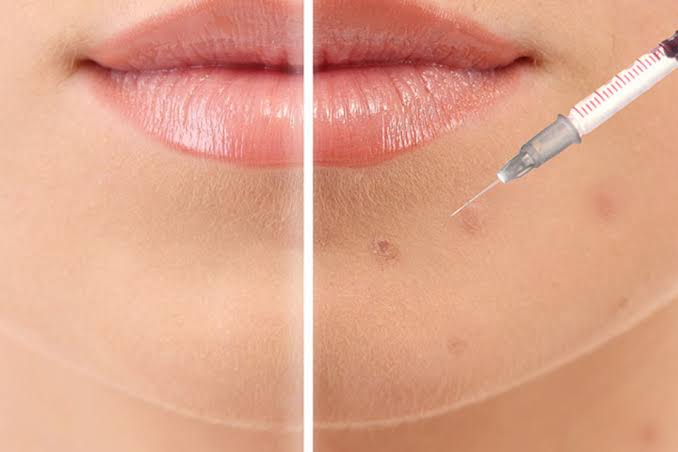 Before and after a Pimple Away injection clearing an inflamed breakout