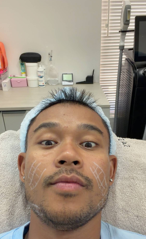 Patient prepped for a laser treatment