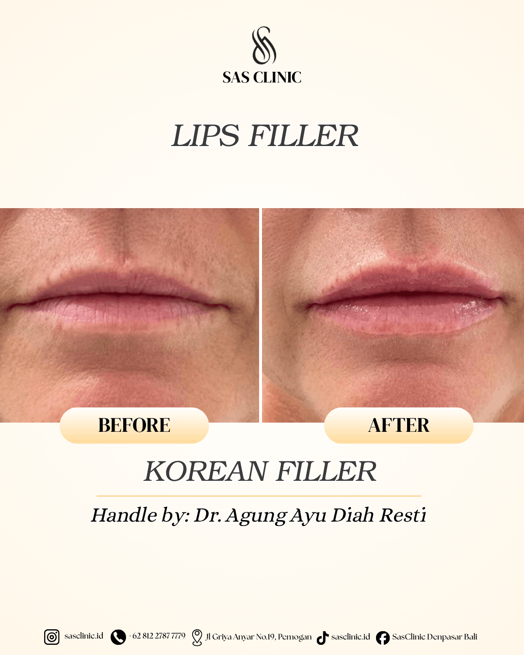 Before and after photos of a Korean filler treatment by Dr. Agung Ayu Diah Resti at SAS Clinic Bali