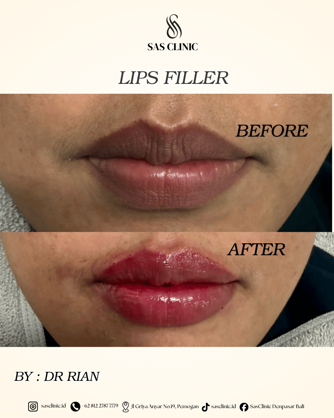 Before and after photos of lip filler by Dr. Rian at SAS Clinic Bali