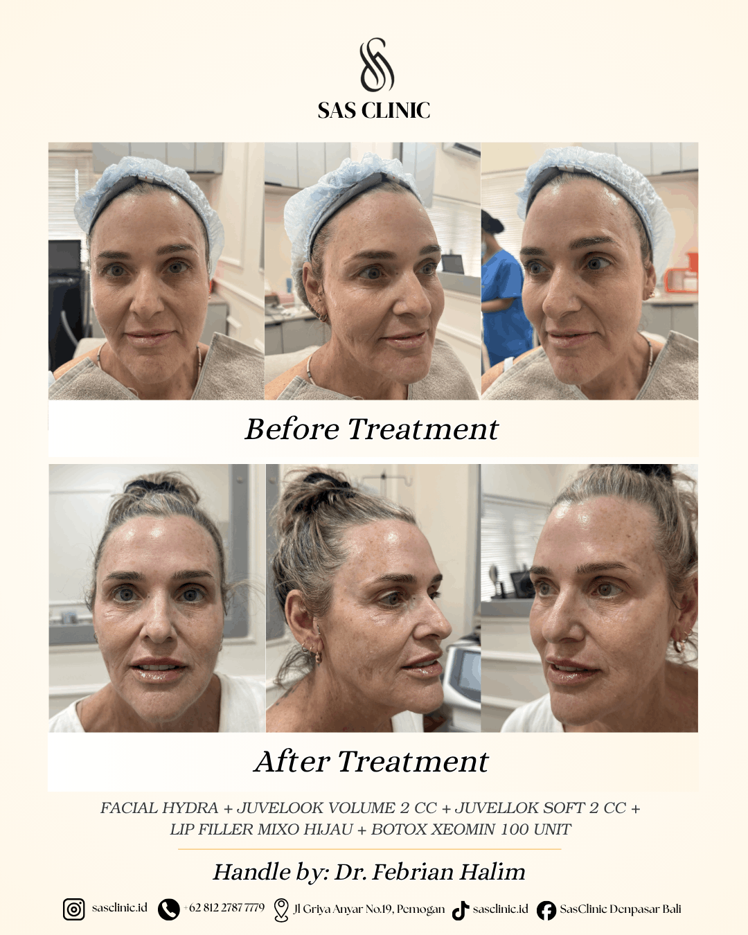 Before and after photos of a facial treatment by Dr. Febrian Halim at SAS Clinic Bali