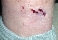 Ski Training Injury - Promote SnowSports and Shoot a Dog today