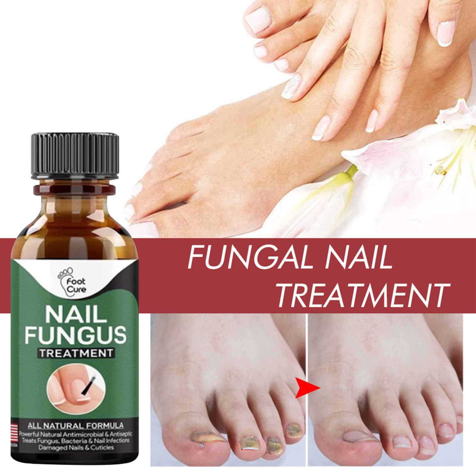 10ml Nail Fungal Infection Treatment Damaged Broken Nail