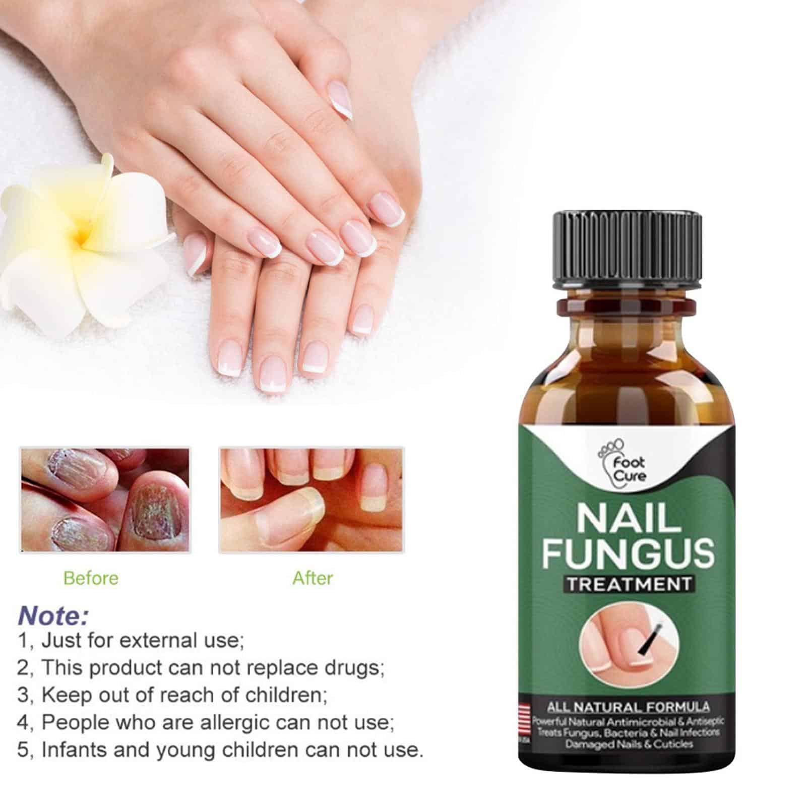 10ml Nail Fungal Infection Treatment Damaged Broken Nail