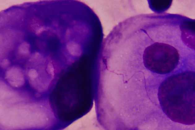 tumor cells tumor cells