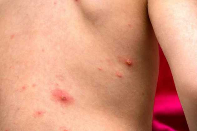 Measles Measles