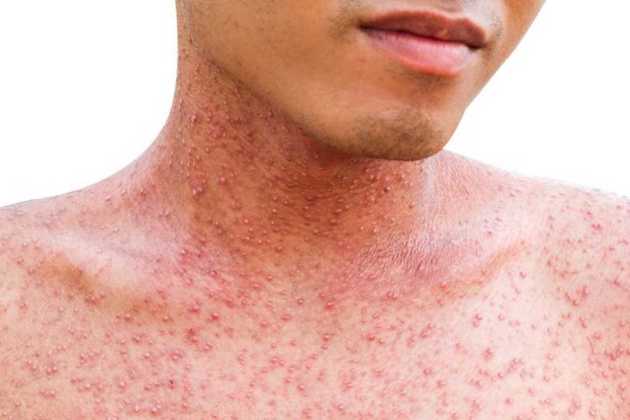 Measles Measles