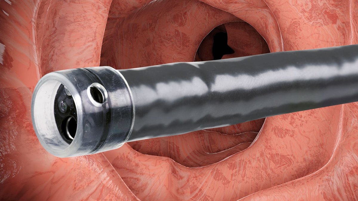 Woman's Swallowed Nails Removed via Colonoscopy - swallowed nails