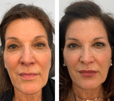 Face Skin Care Before After Comparison 0