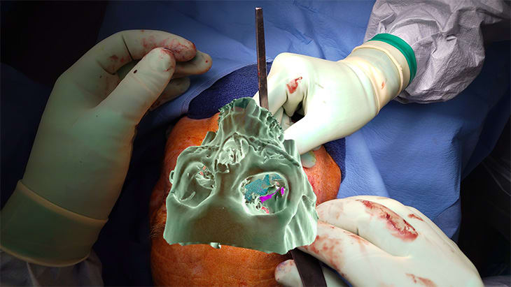 Augmented reality hologram of facial bone anatomy overlaid on a patient's face while gloved hands operate