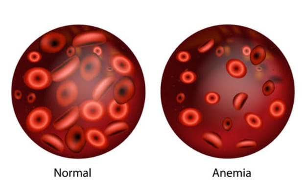 What Is The Best Treatment For Anemia?