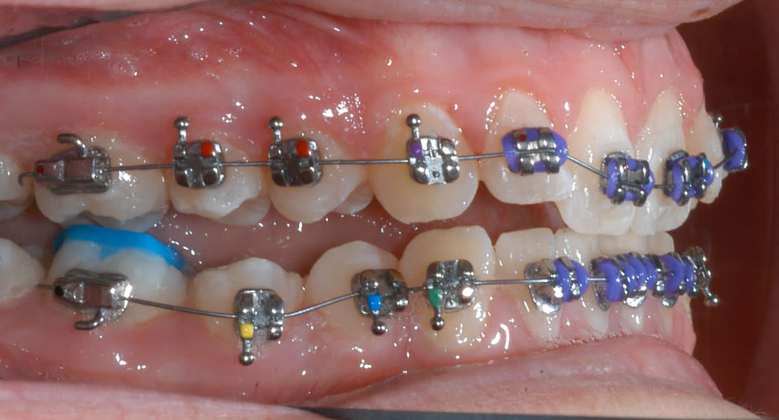 The Best Kind Of Dentists Braces Near Me Longevity