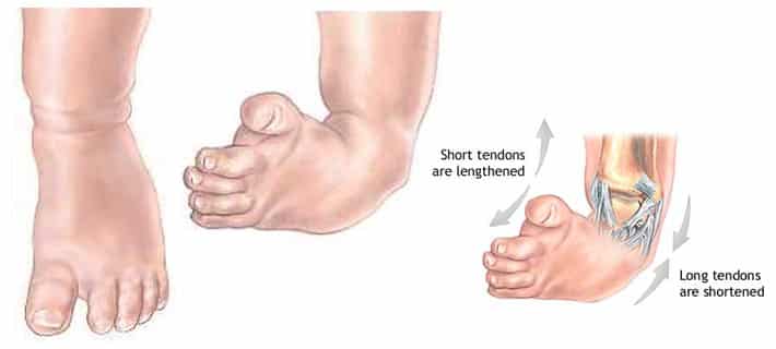 On the cure of club-foot without cutting tendons : and on certain