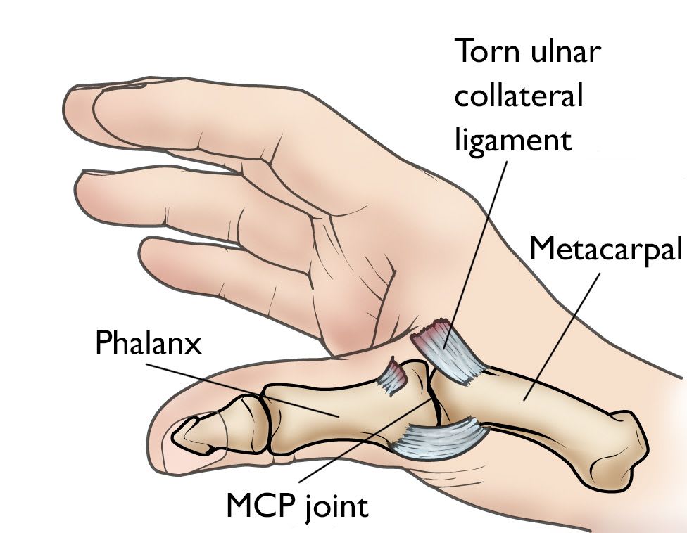 Thumb Sprain Symptoms Causes And Treatment Plan Longevity