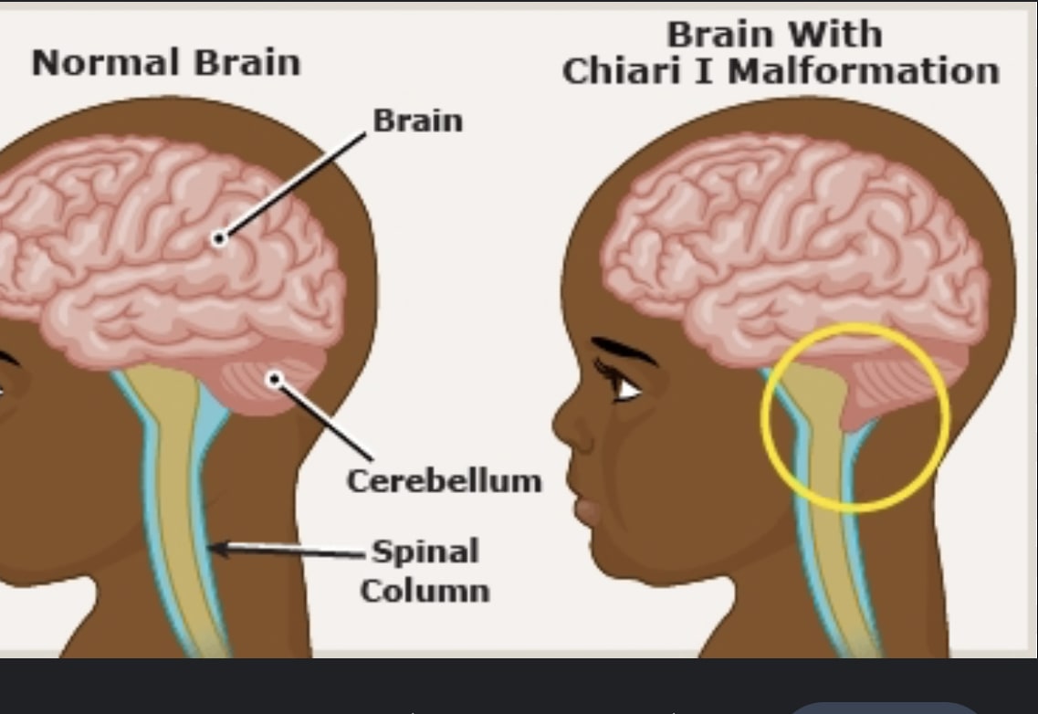 things to avoid with chiari malformation Earth
