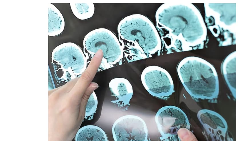 A new gadget translates stroke victims' silent speech