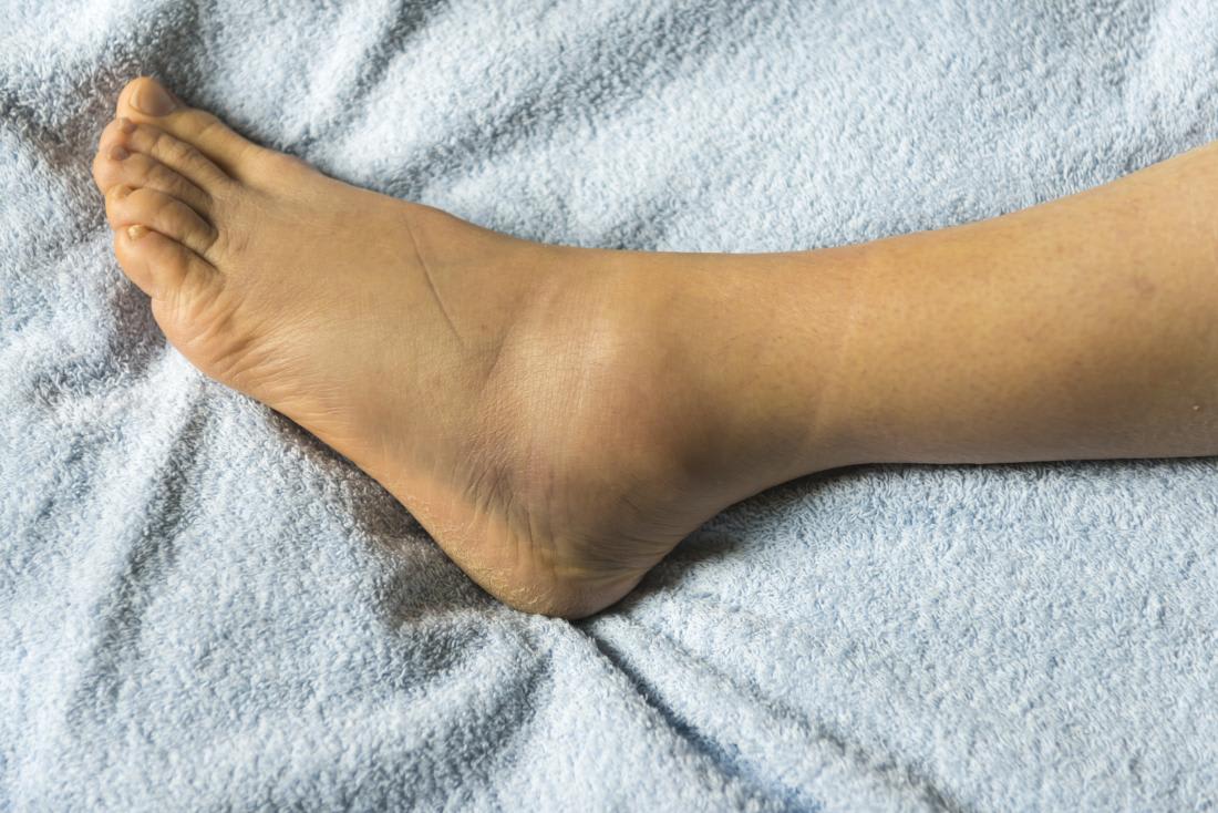 What Causes Swelling In Feet Ankles And Lower Legs