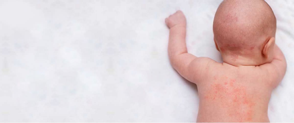 Your Guide to Baby Rashes Families