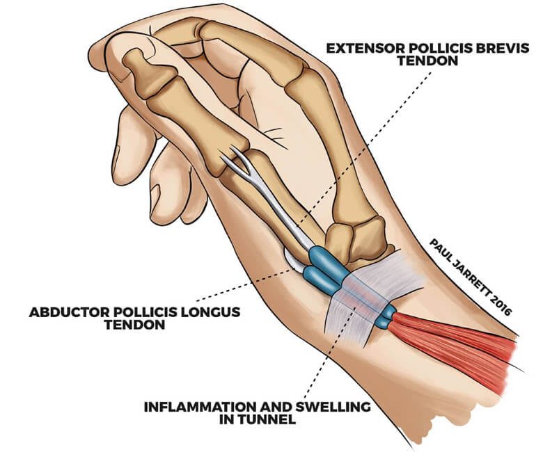 De Quervain Tenosynovitis Symptoms Causes And Treatment Plan