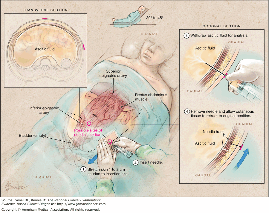 Ascitic Drain Insertion Best Drain Photos