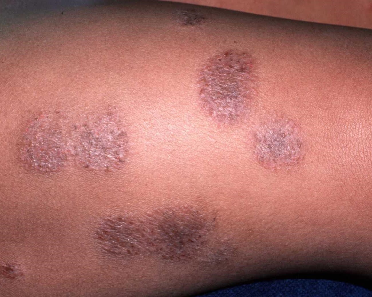 psoriasis skin disease