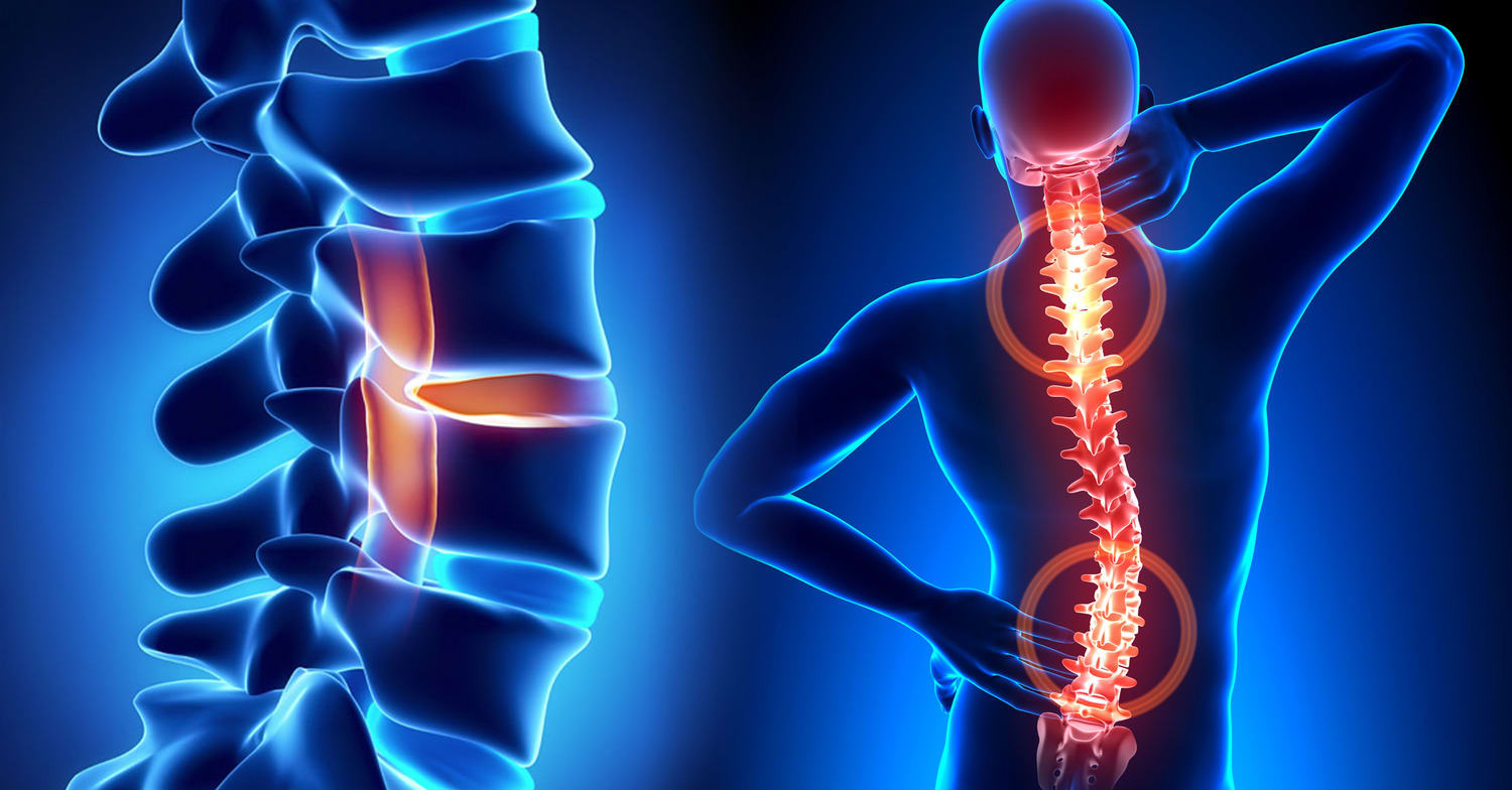 Posture and Spine Pain