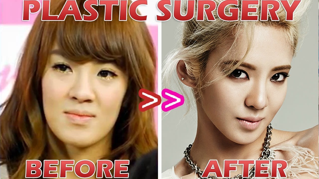 kpop double eyelid surgery