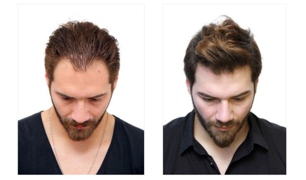 Hair Transplant Trusted  Best Hair Transplantation Clinic in India