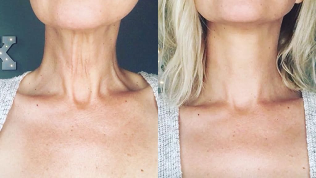NonSurgical Neck Lift How to Tighten Neck Skin Education