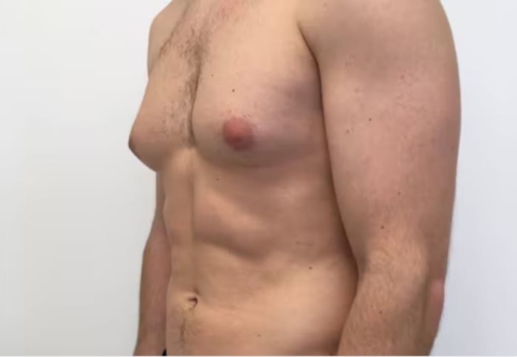 How to Get Rid of Man Boobs - Gynecomastia Exercise and Diet Plan