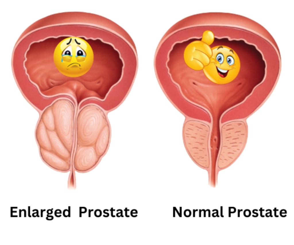 Understanding Prostate Cancer Symptoms: Early Detection and Diagnosis is  Key | Education