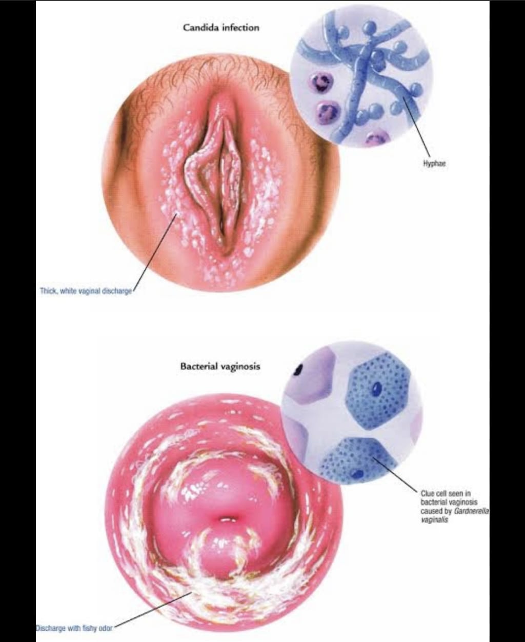 Candida Vulvovaginitis Current Treatment Options For Vulvovaginal