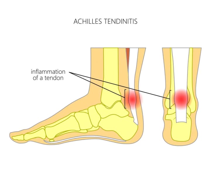 Achilles and his heel